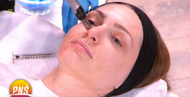 Dermapen – odmładzanie przez nakuwanie